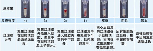 【試驗(yàn)?zāi)康暮驮怼? ABO血型鑒定是通過(guò)檢測(cè)被檢者紅細(xì)胞上是否存在A(yíng)和/或B抗原（正定型）以及被檢者血漿中是否存在抗A和/或抗B抗體（反定型）來(lái)確定。 對(duì)于成年個(gè)體被檢者，紅細(xì)胞上的A和/或B抗原與血漿中的抗A和/或抗B抗體存在一種對(duì)應(yīng)關(guān)系。其獨(dú)特性質(zhì)在于：紅細(xì)胞上缺乏A和/或B抗原，則血清中存在與所缺乏的抗原對(duì)應(yīng)的強(qiáng)反應(yīng)性抗體，如紅細(xì)胞上缺乏A抗原，則可以預(yù)見(jiàn)血漿中存在抗A抗體。 常規(guī)的ABO定型必須包括正定型（紅細(xì)胞定型）和反定型（血漿定型），并將正反定型結(jié)果相互驗(yàn)證，如果紅細(xì)胞發(fā)生凝集，預(yù)期其凝集強(qiáng)度≥2+；只有正反定型結(jié)果一致時(shí)才能準(zhǔn)確定型。 20121212104627668.jpg  然而，有時(shí)ABO正定型和反定型會(huì)出現(xiàn)結(jié)果不一致現(xiàn)象，或陽(yáng)性反應(yīng)強(qiáng)度弱于2+。引起正反定型結(jié)果不一致因素有： （一）正定型出現(xiàn)弱反應(yīng)或缺失抗原 1. A亞型、B亞型或AB亞型。 2. 白血病導(dǎo)致A或B抗原減弱。 3. 何杰金?。℉odgkin’s）有時(shí)會(huì)抑制抗原表達(dá)，與白血病類(lèi)似。 4. 由于某種疾?。ㄈ绺骨话⒁认侔?dǎo)致血漿中存在大量的型物質(zhì)，中和抗A或抗B抗體，引起正定型為假陰性或弱陽(yáng)性。需要將正定型的紅細(xì)胞用生理鹽水洗滌后再次定型可解決此問(wèn)題。 5. 骨髓移植 6. 非ABO同型輸血 （二）正定型紅細(xì)胞上多余的抗原反應(yīng) 1. 自身凝集紅細(xì)胞、抗體致敏紅細(xì)胞導(dǎo)致。 2. 細(xì)胞未洗滌，血漿蛋白引起的假陽(yáng)性反應(yīng)。 3. 細(xì)胞未洗滌，血漿中存在針對(duì)正定型試劑中某種成分的抗體導(dǎo)致。 4. 骨髓移植。 5. 獲得性B。 6. B（A）現(xiàn)象。 7. ABO非相合輸注。 （三）正定型出現(xiàn)混合視野反應(yīng) 1. 近期輸血。 2. 骨髓移植。 3. 異卵雙胞胎或雙受精卵產(chǎn)生的嵌合體。 4. 胎兒和母體出血。 5. A3亞型。 （四）反定型血清中出現(xiàn)弱反應(yīng)或反應(yīng)缺失 1. 年齡相關(guān)：新生兒以及小于6月齡的嬰兒以及老年人。 2. ABO亞型有亞型抗體，如A2、A2B型人的抗A1。 3. 低球蛋白血癥（如白血病人、使用免疫抑制劑患者、免疫缺陷患者）。 4. 移植患者使用抗排異藥物。 5. 雙胞胎或雙受精卵產(chǎn)生的嵌合體。 （五）反定型出現(xiàn)多余的抗體反應(yīng) 1. 冷自身抗體。 2. 特異性冷同種抗體。 3. 血清中存在針對(duì)試劑紅細(xì)胞保存液成分的抗體。 4. 某些疾病導(dǎo)致球蛋白水平增高（多發(fā)性骨髓瘤、巨球蛋白血癥、Hodgkin’s 淋巴瘤）引起緡錢(qián)狀凝集。 5. 輸用大分子血漿擴(kuò)容劑。 6. 非ABO同型的移植。 7. 靜脈注射免疫球蛋白。 （六）技術(shù)方面的錯(cuò)誤 1. 血液樣本被污染，如混入其他人樣本。 2. 被檢紅細(xì)胞的濃度過(guò)高或過(guò)低。 3. 忘記在反應(yīng)體系中加入檢測(cè)樣本或試劑。 4. 未按照試劑使用說(shuō)明進(jìn)行試驗(yàn)。 5. 離心步驟離心時(shí)間不足或離心時(shí)間超時(shí)。 6. 對(duì)試驗(yàn)結(jié)果記錄或判讀不正確。 為了解決ABO亞型引起的ABO正反定型不一致以及正定型紅細(xì)胞上抗原產(chǎn)生弱反應(yīng)或抗原反應(yīng)性缺失，可以使用ABO亞型定型卡來(lái)輔助血型鑒定。 ABO亞型定型卡系采用凝膠作為微柱凝膠卡的填充物，將生物化學(xué)的凝膠分子篩過(guò)濾技術(shù)、離心技術(shù)和血型血清學(xué)的抗體特異性結(jié)合在一起。每卡有八個(gè)凝膠管，其中抗A凝膠管灌注了含抗A抗體的凝膠；抗A1凝膠管灌注了含抗A1抗 體的凝膠；抗B凝膠管灌注了含抗B抗體的凝膠；抗AB凝膠管灌注了含抗AB抗體的凝膠；抗H凝膠管灌注了含抗H抗體的凝膠；A細(xì)胞、B細(xì)胞及Ctl管中灌 注了不含血型抗體的凝膠，A細(xì)胞、B細(xì)胞用于檢測(cè)血漿中的抗體，Ctl管用于自身對(duì)照。當(dāng)抗原抗體反應(yīng)時(shí)，凝集的紅細(xì)胞在離心力的作用下不能通過(guò)凝膠而留 在凝膠上層或游離在凝膠中，呈現(xiàn)陽(yáng)性反應(yīng)；而抗原抗體沒(méi)有反應(yīng)時(shí)，未凝集的紅細(xì)胞在離心力的作用下可通過(guò)凝膠而沉積在微柱凝膠管的底部，呈現(xiàn)陰性反應(yīng)。 【ABO亞型定型卡的用途】 鑒定紅細(xì)胞上的ABO抗原，解決亞型引起ABO正反定型不一致、以及正定型紅細(xì)胞上抗原產(chǎn)生弱反應(yīng)或抗原反應(yīng)性缺失的問(wèn)題。 【樣本要求】 1. 建議使用抗凝的血樣，尤其是EDTA抗凝管采集的血樣，需要量2ml。（EDTA抗凝采血管為紫帽管）。 2. 血液樣本在采集后48小時(shí)以?xún)?nèi)檢測(cè)。 【所需儀器設(shè)備及耗材】 1. ABO亞型定型卡 2. 血型血清學(xué)離心機(jī)（用于離心分離血漿、洗滌紅細(xì)胞） 3. 微柱凝膠卡離心機(jī) 4. 微量移液槍及吸頭 【試驗(yàn)操作】  一、被檢血液樣本的處理 1. EDTA抗凝的血液樣本離心3000rpm 1分鐘，將上清血漿轉(zhuǎn)入一支12×75mm試管中備用，得到壓積紅細(xì)胞。 2. 另取一支12×75mm試管中，加入0.1ml上述步驟1中的壓積紅細(xì)胞 ，用生理鹽水洗滌一次，棄上清，得到壓積紅細(xì)胞。 3. 在一支12×75mm 試管中，加入1ml生理鹽水（或LISS液），加入步驟2中得到的壓積紅細(xì)胞10μl，混勻得到0.8~1%的被檢紅細(xì)胞懸液。 二、 紅細(xì)胞定型 1. 取ABO亞型定型卡一片，注意檢查外觀(guān)，確保凝膠管的凝膠上層存在液面，凝膠不會(huì)干枯。將符合要求的卡進(jìn)行標(biāo)記，按照試驗(yàn)需要撕開(kāi)封口膜。 2. 用微量移液槍分別向每孔樣品槽中沿樣品槽內(nèi)壁呈45°角緩慢加入50μl 0.8~1%的被檢者紅細(xì)胞懸液。 3. 在臺(tái)面交替輕叩卡左下角和右下角，確保所加入的液體在卡的樣品槽中呈水平狀態(tài)，而不是偏向一側(cè)。 4. 將卡放入微柱凝膠卡離心機(jī)離心，LB-3000低速離心機(jī)第一檔離心900rpm 2分鐘，再1500rpm 3分鐘，判讀結(jié)果并記錄。 【結(jié)果判讀及解釋】 1. 反應(yīng)陰、陽(yáng)性的判讀 20121212104658937.jpg 2. 陰陽(yáng)性結(jié)果解釋 (1) 陽(yáng)性結(jié)果：紅細(xì)胞浮在凝膠表面或膠中，為陽(yáng)性反應(yīng)。 (2) 陰性結(jié)果：紅細(xì)胞全部沉于微柱凝膠的底部。 (3) 血型亞型鑒定需要根據(jù)正反定型結(jié)果來(lái)判定，結(jié)果判定可參考下表。 20121212104720212.jpg 注：mf=混合視野，w=弱反應(yīng)。 【注意事項(xiàng)】 1. 建議在使用凝膠卡前先離心再應(yīng)用。 2. 若凝膠卡封口開(kāi)裂、孔中凝膠干涸或有氣泡，不可使用。 3. 撕開(kāi)凝膠卡封口膜時(shí)，不能用力過(guò)猛，以免造成凝膠微孔間的交叉污染。 4. 樣本采集后應(yīng)盡快檢測(cè)，若試驗(yàn)需要延遲，應(yīng)將樣本置2~8℃下短期儲(chǔ)存。 5. 紅細(xì)胞懸液的濃度為0.8~1%，濃度過(guò)高或過(guò)低會(huì)影響檢測(cè)結(jié)果。 6. 溶血、脂血、細(xì)菌污染等情況的標(biāo)本會(huì)影響檢測(cè)結(jié)果。 7. 血漿或血清標(biāo)本須充分離心去除纖維蛋白，否則會(huì)阻止紅細(xì)胞在微柱凝膠中的沉降，出現(xiàn)假陽(yáng)性。 8. 在Ctl孔（自身陰性對(duì)照）結(jié)果為陽(yáng)性時(shí)，試驗(yàn)結(jié)果無(wú)效?？赡茉蚴怯捎诒粰z紅細(xì)胞已經(jīng)致敏IgM抗體導(dǎo)致自發(fā)凝集，此時(shí)可以用DTT將已經(jīng)致敏到紅細(xì)胞上的IgM抗體破壞后再行試驗(yàn)。 9. 人源血液樣本存在潛在的傳染性，凝膠卡使用后按醫(yī)療生物垃圾處理。