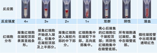 【試驗?zāi)康暮驮怼?    ABO血型鑒定是通過檢測被檢者紅細胞上是否存在A和/或B抗原（正定型）以及被檢者血漿中是否存在抗A和/或抗B抗體（反定型）來確定。  對于成年個體被檢者，紅細胞上的A和/或B抗原與血漿中的抗A和/或抗B抗體存在一種對應(yīng)關(guān)系。其獨特性質(zhì)在于：紅細胞上缺乏A和/或B抗原，則血清中存在與所缺乏的抗原對應(yīng)的強反應(yīng)性抗體，如紅細胞上缺乏A抗原，則可以預(yù)見血漿中存在抗A抗體。  常規(guī)的ABO定型必須包括正定型（紅細胞定型）和反定型（血漿定型），并將正反定型結(jié)果相互驗證，只有正反定型結(jié)果一致時才能準(zhǔn)確定型。  Rh陽性和Rh陰性的鑒定是通過檢測被檢者的紅細胞上是否有D抗原，有D抗原為Rh陽性，沒有D抗原則為Rh陰性。  ABO/RhD血型定型檢測試劑卡采用凝膠作為微柱凝膠卡的填充物，將生物化學(xué)的凝膠分子篩過濾技術(shù)、離心技術(shù)和血型血清學(xué)的抗體特異性結(jié)合在一起，其中 抗A凝膠管中灌注了含抗A抗體的凝膠，抗B凝膠管中灌注了含抗B抗體的凝膠，抗D凝膠管中灌注了含IgM抗D抗體的凝膠。A細胞、B細胞及Ctl管中灌注 了不含血型抗體的凝膠，抗A、抗B及抗D凝膠管用于紅細胞上A、B及D抗原檢測，而A細胞、B細胞用于檢測血漿中的抗體，Ctl管用于自身對照。當(dāng)抗原抗 體反應(yīng)時，凝集的紅細胞在離心力的作用下不能通過凝膠而留在凝膠上層或游離在凝膠中，呈現(xiàn)陽性反應(yīng)；而抗原抗體沒有反應(yīng)時，未凝集的紅細胞在離心力的作用 下可通過凝膠而沉積在微柱凝膠管的底部，呈現(xiàn)陰性反應(yīng)。  20121212104122758.jpg       【ABO/RhD血型定型檢測試劑卡的用途】  1.?用于輸血前檢測  (1) 鑒定ABO血型，以備選擇ABO血型相配合的血液用于交叉配血。  (2) 鑒定RhD血型，以備選擇RhD血型相配合的血液用于交叉配血。  2.?用于圍產(chǎn)期檢查  (1)?用于產(chǎn)前夫婦的ABO、RhD血型檢測，進行新生兒溶血病產(chǎn)前預(yù)測。  (2)?用于產(chǎn)后母子的ABO、RhD血型檢測，進行新生兒溶血病產(chǎn)后診斷。  3.?用于常規(guī)ABO、RhD血型化驗檢查，如健康體檢等。  【樣本要求】  1.?建議使用抗凝的血樣，尤其是EDTA抗凝管采集的血樣，需要量2ml 。（EDTA抗凝采血管為紫帽管）。  2.?血液樣本在采集后48小時以內(nèi)檢測。  【所需儀器設(shè)備及耗材】  1.?ABO、RhD血型定型檢測試劑卡  2.?血型血清學(xué)離心機（用于離心分離血漿、洗滌紅細胞）  3.?微柱凝膠卡離心機  4.?微量移液槍及吸頭  【試驗操作】?  按照下列步驟進行操作  一、被檢血液樣本的處理及反定型A型、B型紅細胞的準(zhǔn)備  1.?EDTA抗凝的血液樣本離心3000rpm 1分鐘，將上清血漿轉(zhuǎn)入一支12×75mm 試管中，余下的壓積紅細胞備用。如果血漿有不溶物（如混入的紅細胞）或不澄清透明，則需要將血漿再次離心，直到澄清透明不含不溶物為止。  2.?另取一支12×75mm試管中，加入0.1ml上述步驟1中的壓積紅細胞 ，用生理鹽水洗滌一次，棄上清，得到壓積紅細胞。  3.?在一支12×75mm試管中，加入1ml生理鹽水（或LISS液），加入步驟2中得到的壓積紅細胞10μl，混勻得到0.8~1%的被檢紅細胞懸液。  4.?將反定型A型、B型紅細胞用生理鹽水或LISS液配制成0.8~1%濃度。  二、ABO、RhD定型  1.?取ABO/RhD血型定型檢測試劑卡一片，注意檢查外觀，確保凝膠管的凝膠上層存在液面，凝膠不會干涸。將符合要求的卡進行標(biāo)記，按照試驗需要撕開封口膜。  2.?用微量移液槍分別向抗A、抗B、抗D孔及Ctl孔的每孔樣品槽中沿樣品槽內(nèi)壁呈45°角緩慢加入50μl 0.8~1%濃度的被檢者紅細胞懸液。  3.?向A細胞孔中加入50μl?0.8~1%的A型紅細胞懸液。  4.?向B細胞孔中加入50μl?0.8~1%的B型紅細胞懸液。  5.?分別向A細胞、B細胞、Ctl孔中加入25μl 被檢者血漿。  6.?在臺面交替輕扣卡左下角和右下角，確保所加入的液體在卡的樣品槽中呈水平狀態(tài)，而不是偏向一側(cè)。  7.?將卡放入微柱凝膠卡離心機離心，LB-3000低速離心機第一檔離心900rpm 2分鐘，再1500rpm 3分鐘，判讀結(jié)果并記錄。  【結(jié)果判讀及解釋】  1.?反應(yīng)陰、陽性的判讀  20121212104153407.jpg  【注意事項】  1. 建議在使用凝膠卡前先離心再應(yīng)用。  2. 若凝膠卡封口開裂、孔中凝膠干涸或有氣泡，不可使用。  3. 撕開凝膠卡封口膜時，不能用力過猛，以免造成凝膠微孔間的交叉污染。  4. 樣本采集后應(yīng)盡快檢測，若試驗需要延遲，應(yīng)將樣本置2~8℃下短期儲存。  5. 紅細胞懸液的濃度為0.8~1%，濃度過高或過低會影響檢測結(jié)果。  6. 溶血、脂血、細菌污染等情況的標(biāo)本會影響檢測結(jié)果。  7. 血漿或血清標(biāo)本須充分離心去除纖維蛋白，否則會阻止紅細胞在微柱凝膠中的沉降，出現(xiàn)假陽性。  8. 人源血液樣本存在潛在的傳染性，凝膠卡使用后按醫(yī)療生物垃圾處理。  9. 在Ctl孔（自身陰性對照）結(jié)果為陽性時，試驗結(jié)果無效?？赡茉蚴怯捎诒粰z紅細胞已經(jīng)致敏IgM抗體導(dǎo)致自發(fā)凝集，此時可以用DTT將已經(jīng)致敏到紅細胞上的IgM抗體破壞后再行 ABO、RhD血型檢測。  10. 抗D凝膠不能鑒定弱D、部分D（如DⅥ）抗原。對于患者，如果抗D凝膠管中患者的紅細胞反應(yīng)為陰性，則確定為RhD陰性。  11. 若出現(xiàn)＜2+的弱陽性反應(yīng)，須做進一步試驗才能準(zhǔn)確定型，即確認(rèn)弱反應(yīng)是由于被檢者的抗原減弱還是凝膠微孔之間的交叉污染引起。  12. 若出現(xiàn)混合視野反應(yīng)，需要了解被檢者近期3個月內(nèi)是否有輸血史，或被檢者是否為骨髓移植患者。  13. 由于6月齡以下的嬰兒其血漿/血清中不似成人一樣存在可預(yù)見的抗A/抗B抗體，因此只做正定型不做反定型。  【ABO正反定型不一致原因分析】  如果血型定型正反定型結(jié)果不一致時，則不能準(zhǔn)確定型，需要分析產(chǎn)生不一致的原因。 引起正反定型不一致的原因如下：  （一）正定型出現(xiàn)弱反應(yīng)或缺失抗原  1. A亞型、B亞型或AB亞型。  2. 白血病導(dǎo)致A或B抗原減弱。  3. 何杰金?。℉odgkin’s）有時會抑制抗原表達，與白血病類似。  4. 由于某種疾?。ㄈ绺骨话?、胰腺癌）導(dǎo)致血漿中存在大量的血型物質(zhì)，中和抗A或抗B抗體，引起正定型為假陰性或弱陽性。 需要將正定型的紅細胞用生理鹽水洗滌后再次定型可解決此問題。  5. 骨髓移植。  6. 非ABO同型輸血。  （二）正定型紅細胞上多余的抗原反應(yīng)  1. 自身凝集紅細胞、抗體致敏紅細胞導(dǎo)致。  2. 細胞未洗滌，血漿蛋白引起的假陽性反應(yīng)。  3. 細胞未洗滌，血漿中存在針對正定型試劑中某種成分的抗體導(dǎo)致。  4. 骨髓移植。  5. 獲得性B。     6. B（A）現(xiàn)象。?  7. ABO非相合輸注。?  （三）正定型出現(xiàn)混合視野反應(yīng)?  1. 近期輸血。?  2. 骨髓移植。?  3. 異卵雙胞胎或雙受精卵產(chǎn)生的嵌合體。?  4. 胎兒和母體出血。?  （四）反定型血清中出現(xiàn)弱反應(yīng)或反應(yīng)缺失?  1. 年齡相關(guān)：新生兒以及小于6月齡的嬰兒以及老年人。?  2. ABO亞型有亞型抗體，如A2、A2B型人的抗A1。?  3. 低球蛋白血癥（如白血病人、使用免疫抑制劑患者、免疫缺陷患者）。?  4. 移植患者使用抗排異藥物。?  5. 雙胞胎或雙受精卵產(chǎn)生的嵌合體。?  （五）反定型出現(xiàn)多余的抗體反應(yīng)?  1. 冷自身抗體。?  2. 特異性冷同種抗體A。?  3. 血清中存在針對試劑紅細胞保存液成分的抗體。?  4. 某些疾病導(dǎo)致球蛋白水平增高（多發(fā)性骨髓瘤、巨球蛋白血癥、Hodgkin’s　淋巴瘤）引起緡錢狀凝集?！? 5. 輸用大分子血漿擴容劑。?  6. 非ABO同型的移植。?  7. 靜脈注射免疫球蛋白。?  （六）技術(shù)方面的錯誤?  1. 血液樣本被污染，如混入其他人樣本。?  2. 被檢紅細胞的濃度過高或過低。?  3. 忘記在反應(yīng)體系中加入檢測樣本或試劑。?  4. 未按照試劑使用說明進行試驗。?  5. 離心步驟離心時間不足或離心時間超時。?  6. 對試驗結(jié)果記錄或判讀不正確。